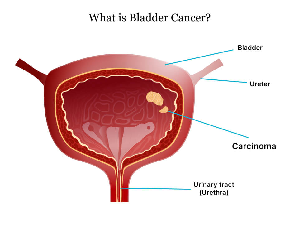 Illustration of bladder cancer and affected bladder lining