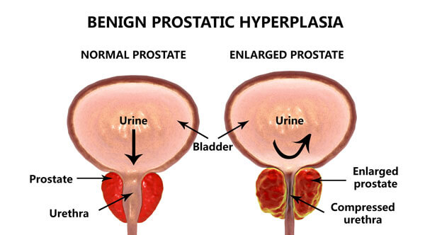 Benign Prostatic Hypertrophy (BPH)