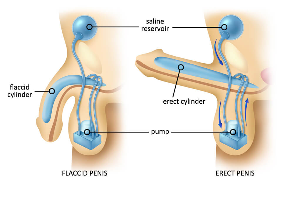 Erectile Dysfunction (ED)