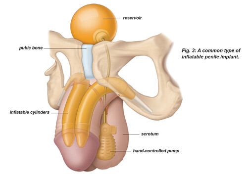 Inflatable Penile Implant in Anatomical Position