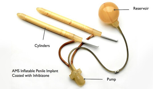 Inflatable Penile Implant