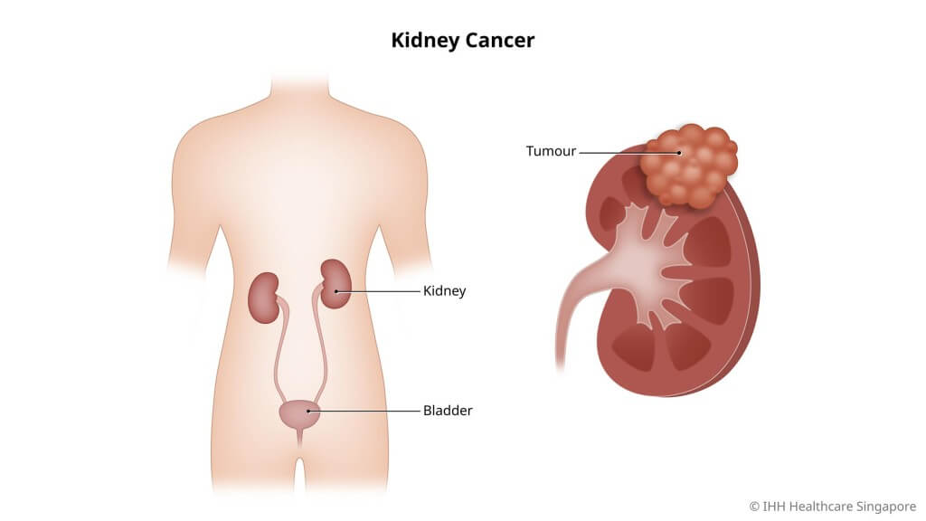 Illustration of kidney cancer and tumor location