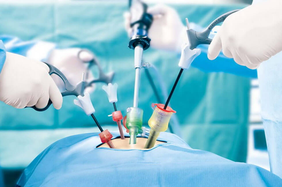 Laparoscopic Surgery