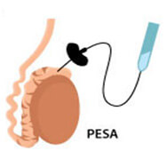 PESA sperm retrieval procedure diagram