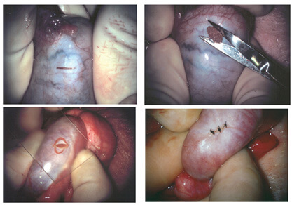 Micro-TESE surgical sperm retrieval under microscope