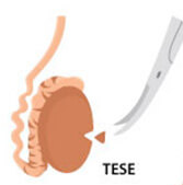 TESE testicular sperm extraction procedure