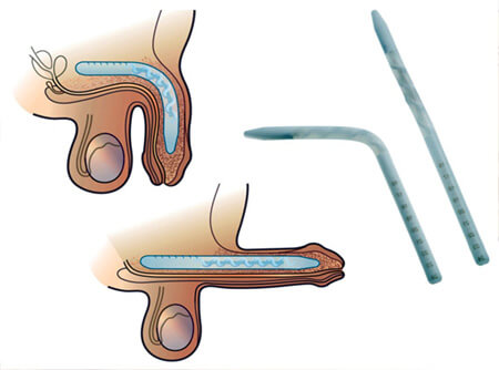 Malleable Implant