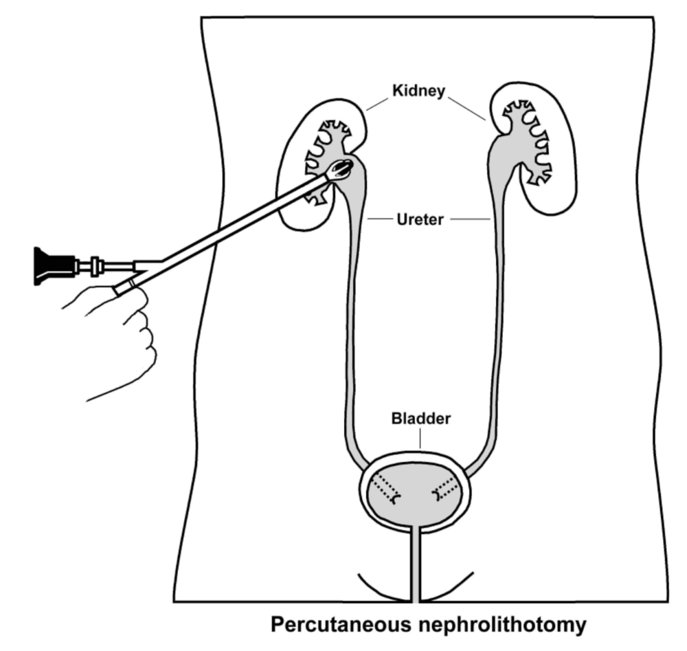 PCNL procedure for kidney stone removal