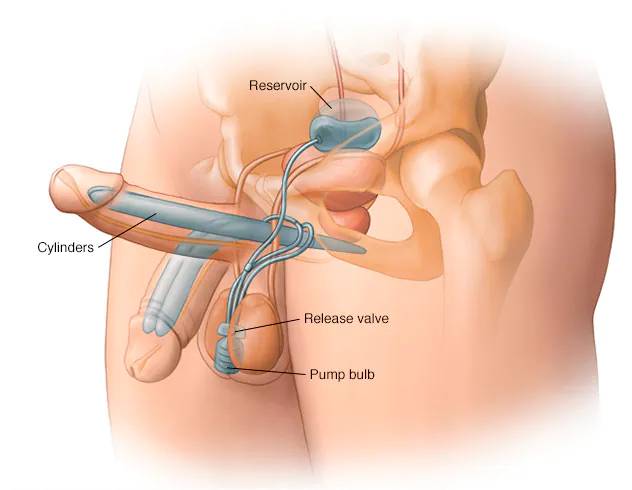 Penile enlargement surgery consultation and treatment options