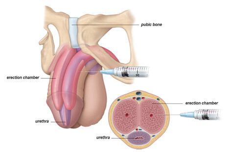 Penile Injections
