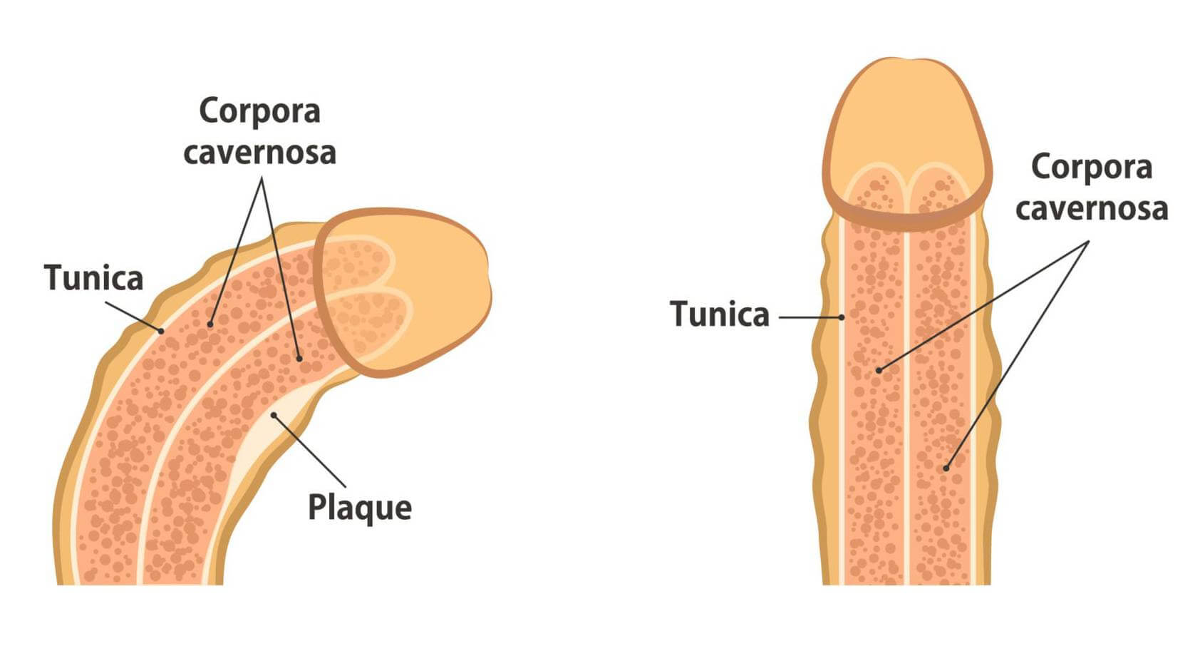 Diagram illustrating Peyronie's disease and penile curvature