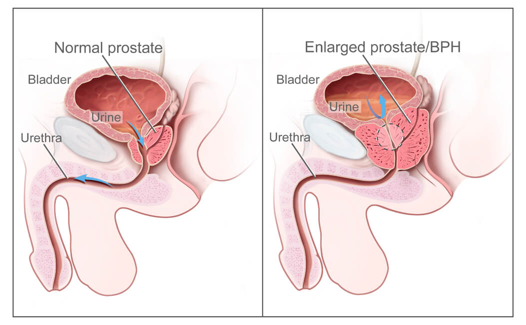 Illustration of prostate cancer and gland anatomy