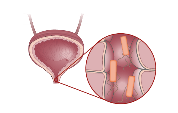 Reconstructive urology surgical procedures diagram