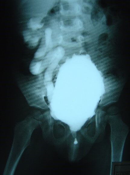 How is Neurogenic Bladder Treated?