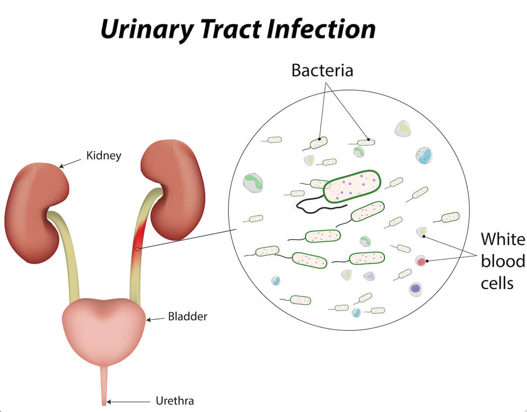 Urinary Tract Infection in Children