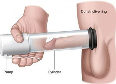 Non-Surgical Treatments for ED