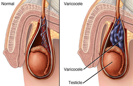 Varicocele diagram showing enlarged scrotal veins