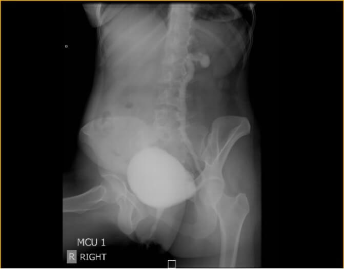VESICOURETERAL REFLUX IN CHILDREN (VUR)
